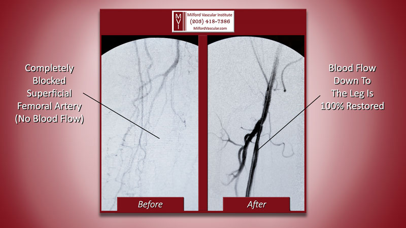 Blocked Leg Artery Completely by PAD Doctors in New Haven CT