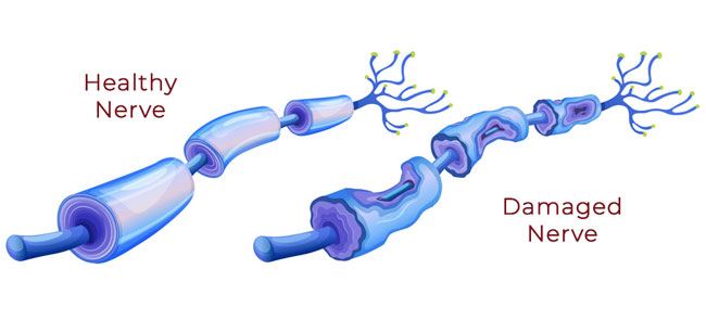 Diabetic Neuropathy Is A Type Of Nerve Damage