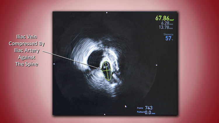 IVUS Procedure for Treating May-Thurner Syndrome New Haven CT