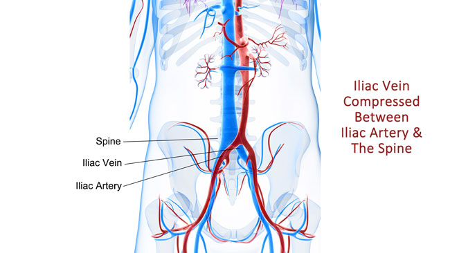 May-Thurner Syndrome Treatment New Haven CT Using IVUS Intravascular Ultrasound