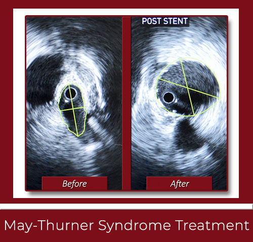 May-Thurner Syndrome Treatment New Haven CT Using IVUS Intravascular Ultrasound