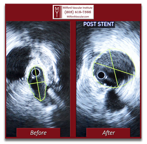 May-Thurner Syndrome Treatment New Haven CT by Best Vascular Surgeons