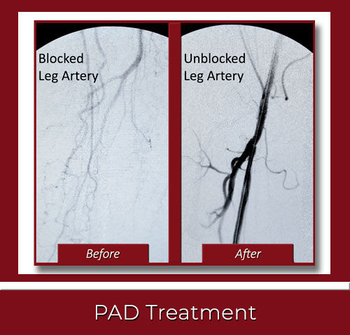 PAD Treatment New Haven CT by Best Vascular Specialist