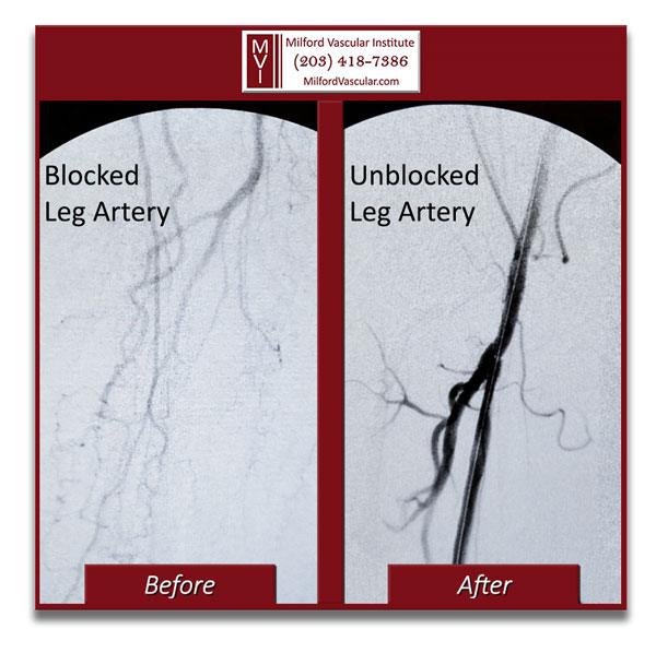 PAD Treatment New Haven CT by Best Vascular Specialists