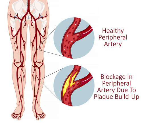 Peripheral Arterial Disease New Haven CT