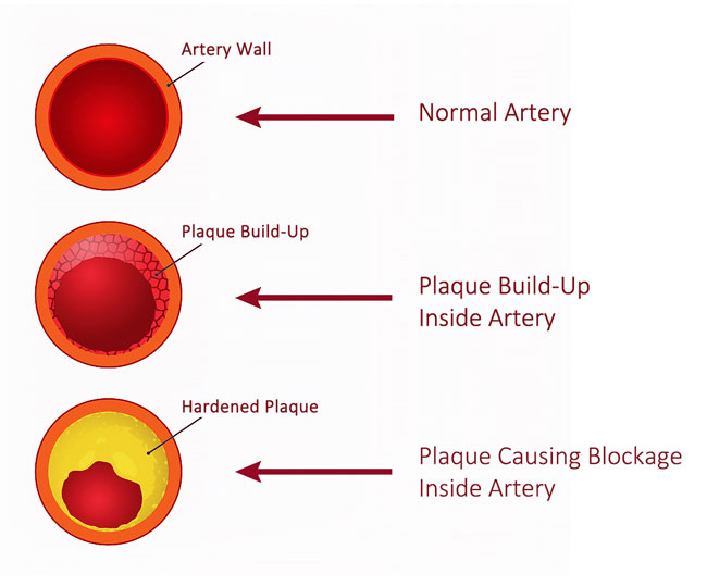 Plaque Buildup Inside Artery Due To Peripheral Artery Disease