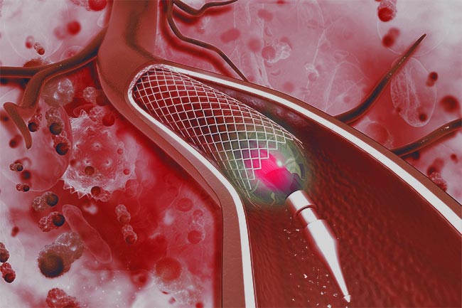 Stent and Balloon Placement for May-Thurner Syndrome Treatment Bridgeport CT