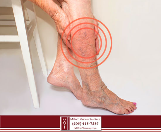 Venous Insufficiency New Haven CT - Leg Pain