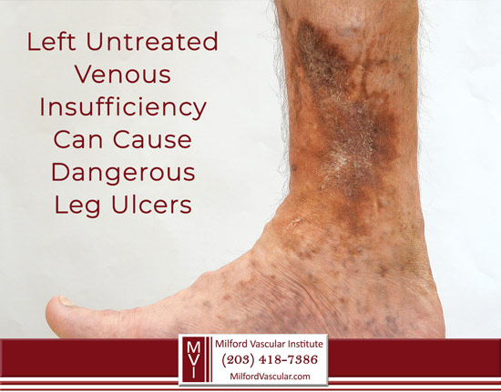 Venous Insufficiency Treatment Bridgeport CT