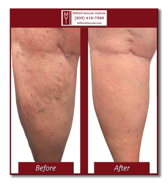 Venous Insufficiency Treatment New Haven CT Best Vein Surgeons