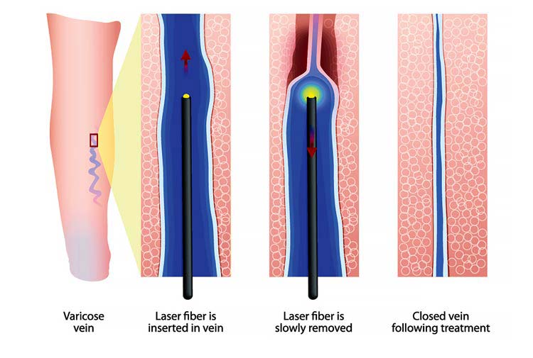 Laser Vein Removal New Haven CT by Best Vascular Surgeons