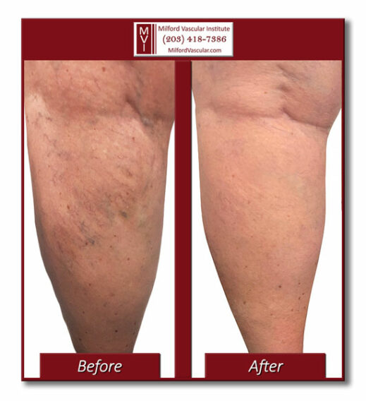 Spider Vein Removal New Haven CT by Best Vein Specialists