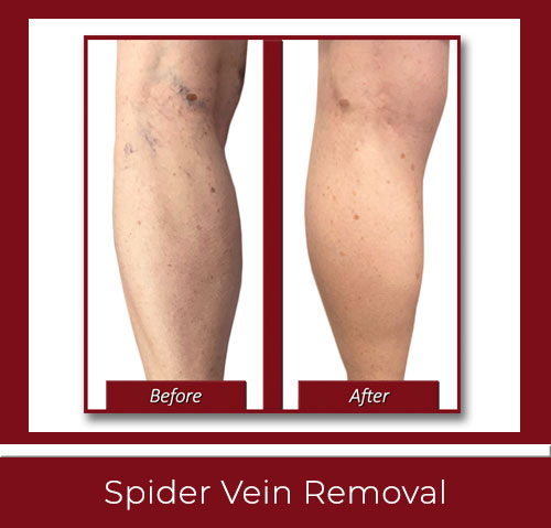 Spider Vein Removal New Haven CT by Best Vein Specialists