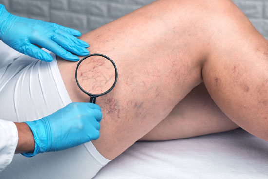 Spider Veins Bridgeport CT