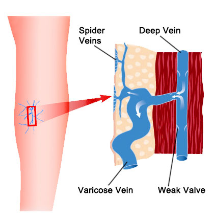 Spider Veins New Haven CT