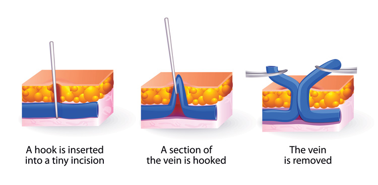 Varicose Vein Removal New Haven CT