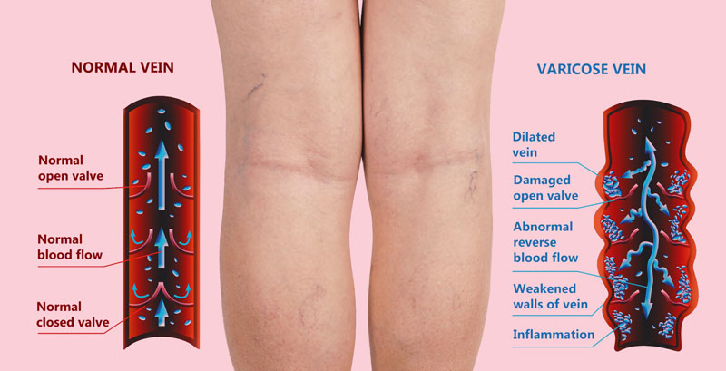 Varicose Vein Treatment New Haven CT