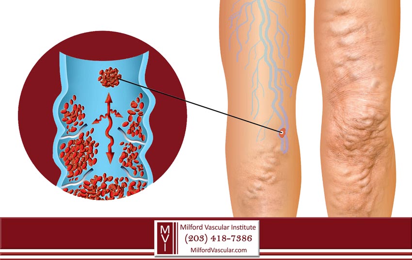 Are Varicose Veins Dangerous? What Are The Symptoms & Treatments? - Laser  Vascular Center