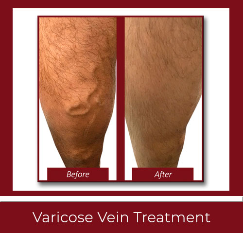 Varicose Veins Surgery New Haven CT by Best Vascular Surgeons