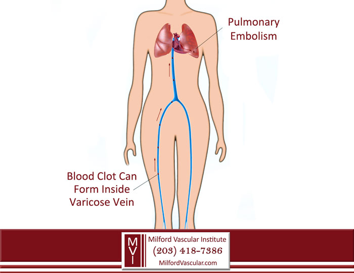 Varicose Veins Surgery New Haven CT