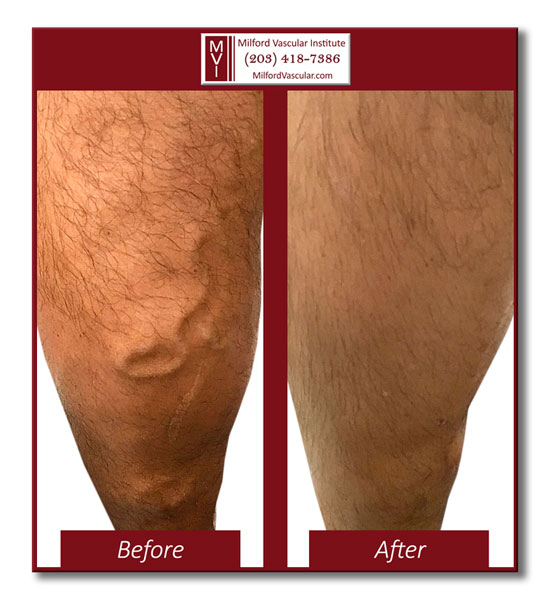 Varicose Veins Surgery New Haven Connecticut