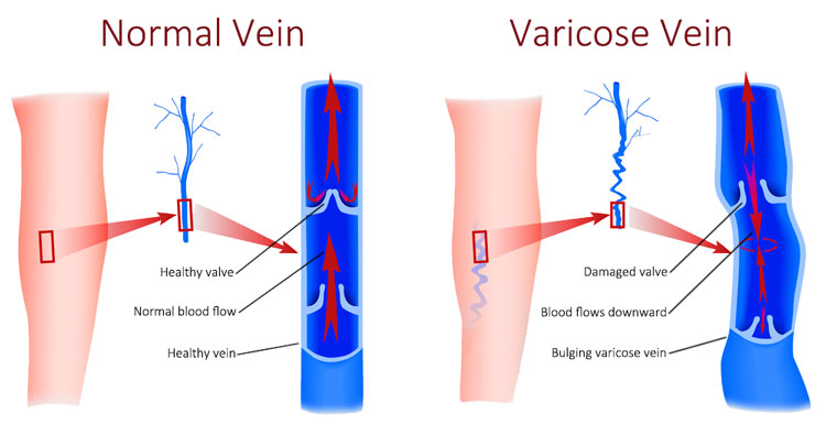 What causes varicose veins in legs