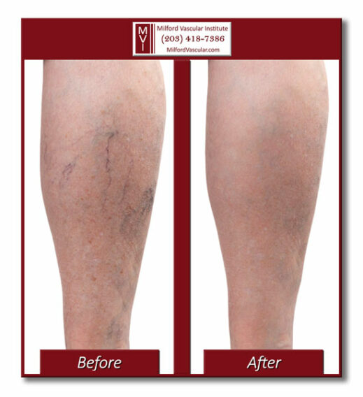 Before and After Vein Treatment New Haven CT