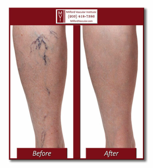 Spider Vein Removal New Haven Before and After