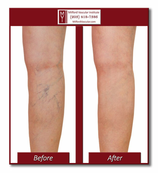 Spider Vein Treatment New Haven Before and After Pictures