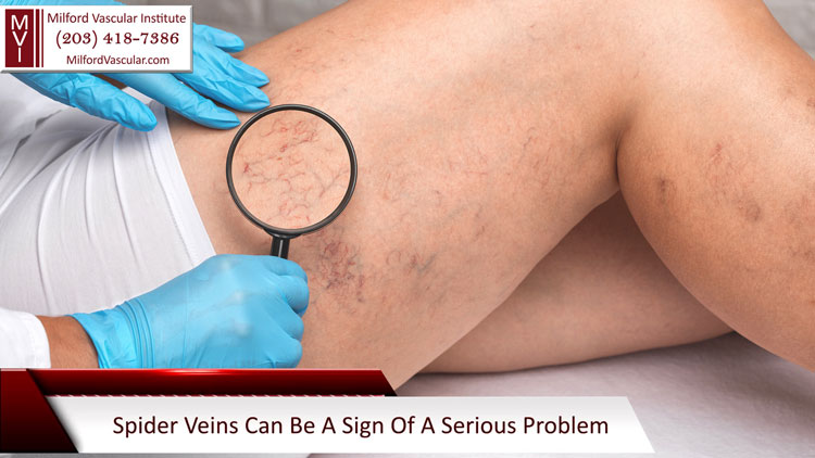 Spider Vein Removal New Haven CT