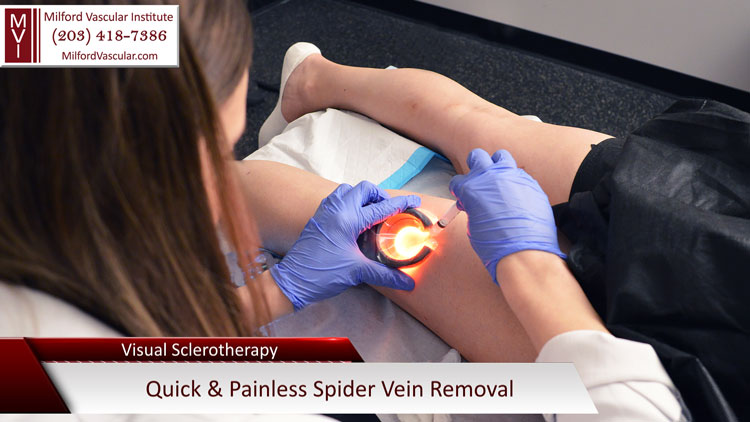 Spider Vein Treatment New Haven CT Using Sclerotherapy