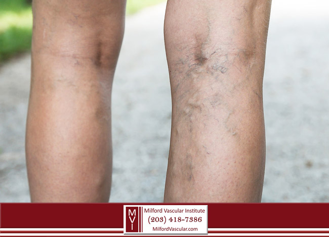 Spider Veins Are A Sign Of A Deeper Vascular Disease