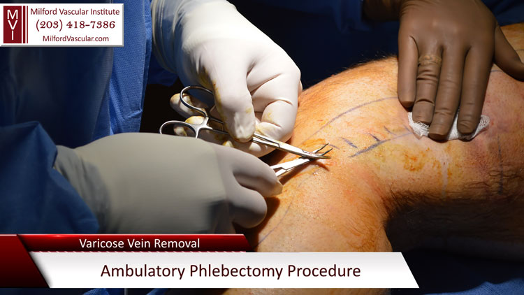 Varicose Vein Ambulatory Phlebectomy New Haven CT by Best Vascular Surgeon David Esposito