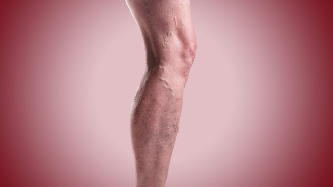 What Are Varicose Veins New Haven CT