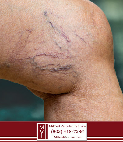 What are spider veins