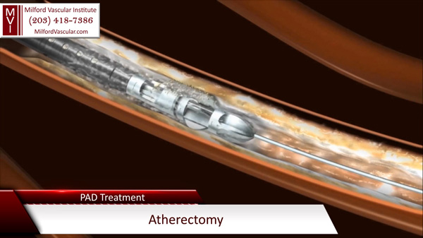 Atherectomy Removes Plaque Inside the Leg Artery During PAD Surgery New Haven CT