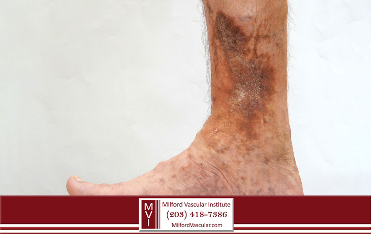 Iliac Vein Compression New Haven CT Causes Leg Ulcers