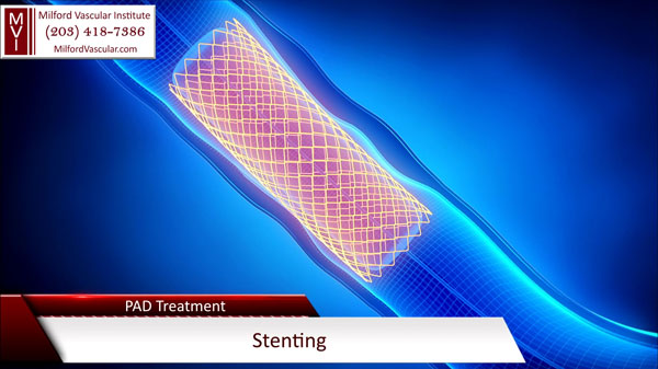 Stent for Peripheral Artery Disease Surgery New Haven CT