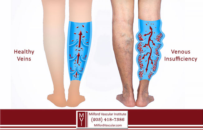 What is Venous Insufficiency New Haven CT