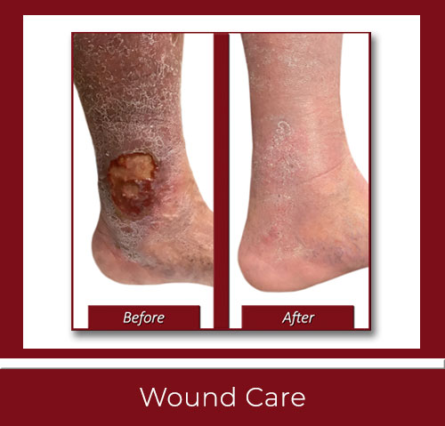 Wound Care Center New Haven CT With Best Vascular Specialists