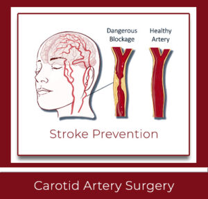 Carotid Artery Surgery in New Haven CT To Prevent Stroke