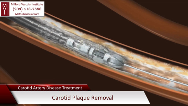 Stent for Carotid Artery Disease Treatment in Stratford Connecticut