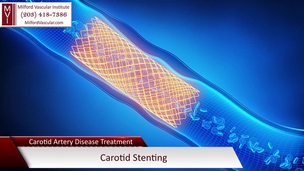 Stent for Carotid Artery Disease Treatment in Stratford Connecticut
