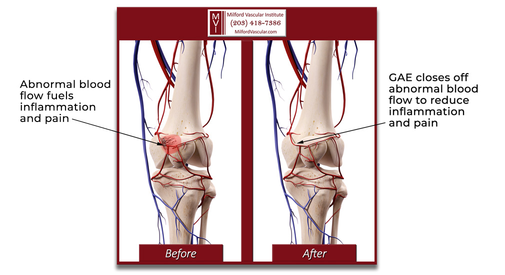 Treatment for Arthritis Knee Pain - GAE Procedure New Haven CT