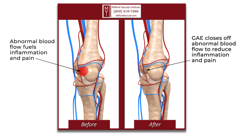 Treatment for Arthritis Knee Pain Using GAE Procedure New Haven CT