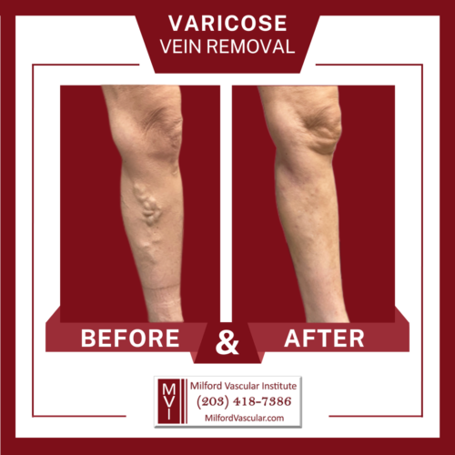Vein Treatment Before and After Stratford CT